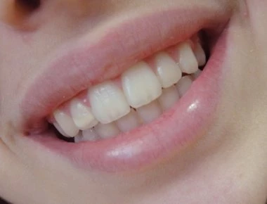 Ορθοδοντική θεραπεία: Σε ποιες περιπτώσεις είναι απαραίτητη και σε ποια ηλικία πρέπει να ξεκινάει